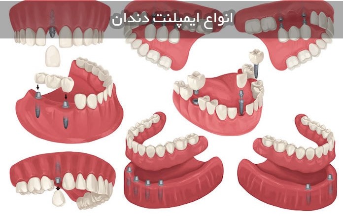 انواع ایمپلنت دندان