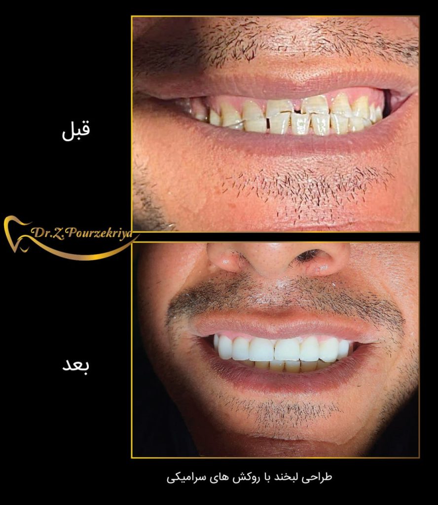 طراحی لبخند با روکش های سرامیکی