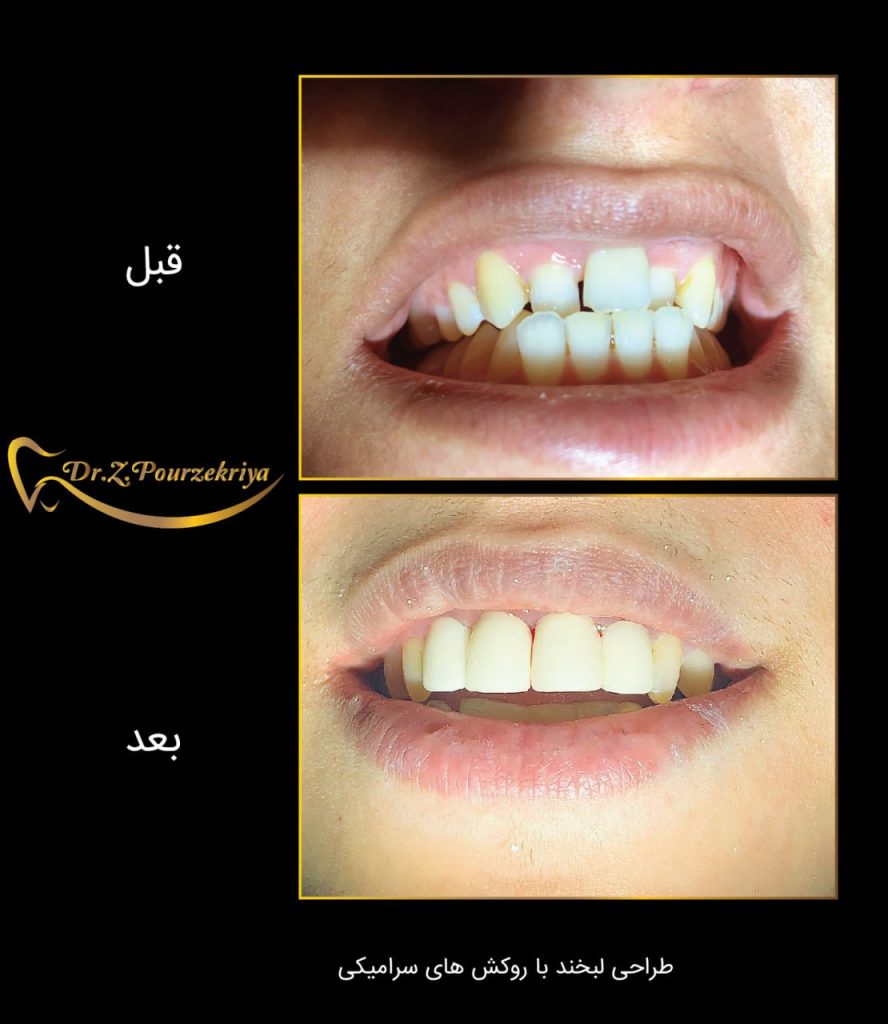 طراحی لبخند با روکش های سرامیکی