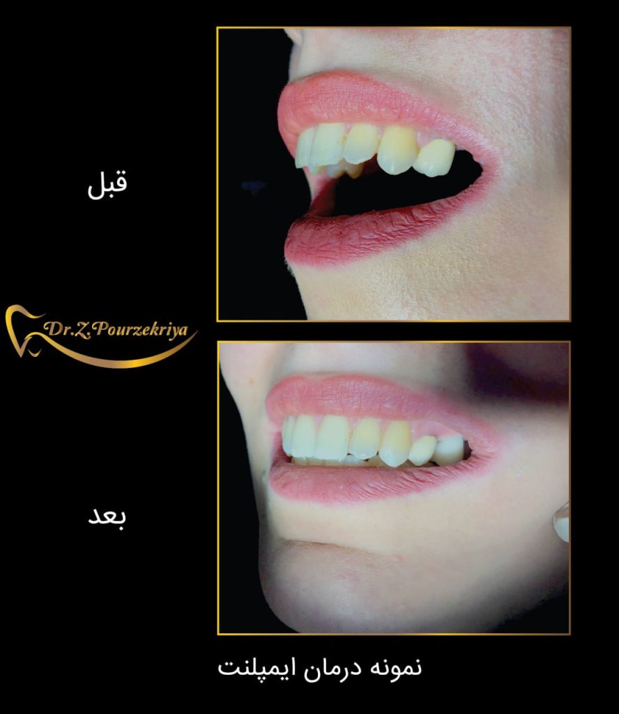 نمونه درمان ایمپلنت