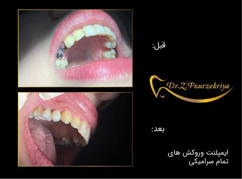 ایمپلنت و روکش سرامیکی