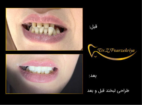 اصلاح طرح لبخند با ارتودنسی در کرج