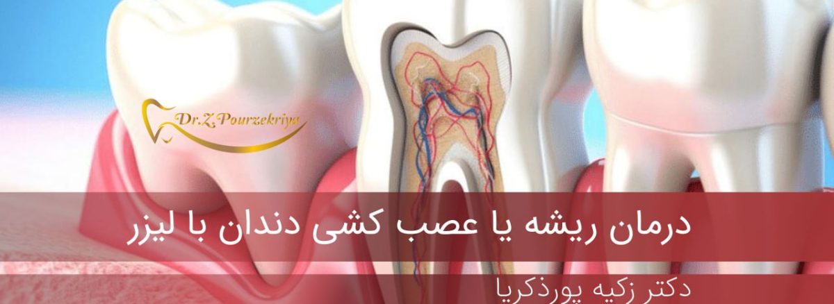 عصب کشی دندان