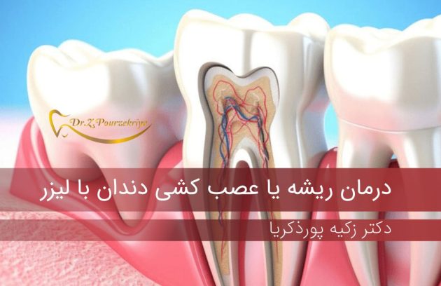 عصب کشی دندان