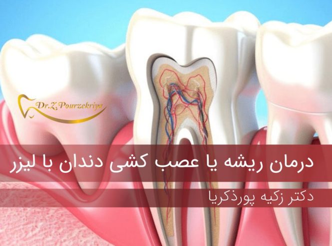 عصب کشی دندان