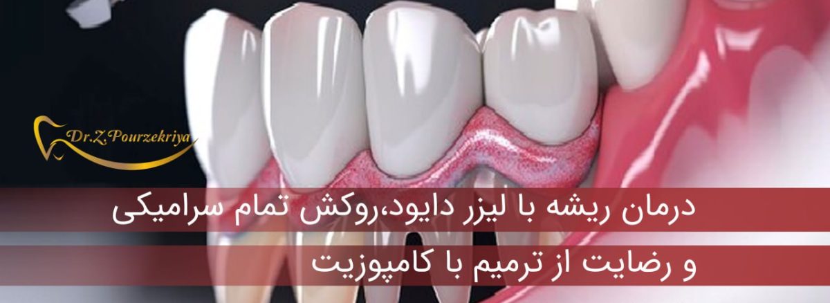 درمان ریشه با لیزر دایود