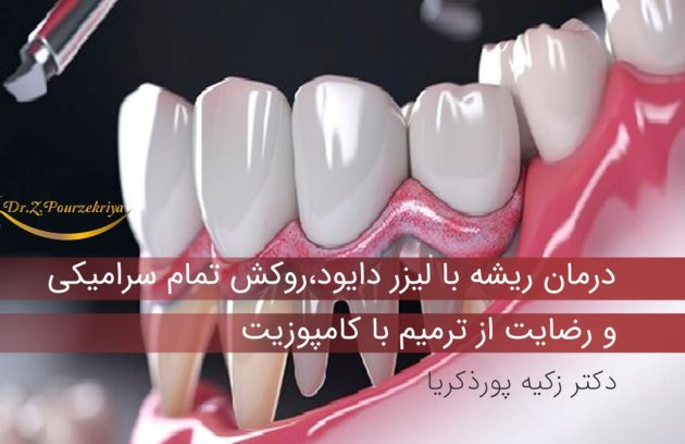 درمان ریشه با لیزر دایود