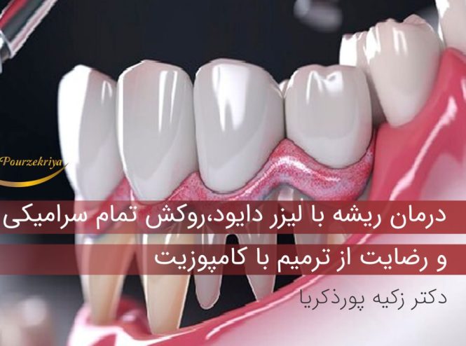 درمان ریشه با لیزر دایود